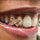 Grillz Dent Double Cœur Givré