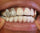 Grillz Double Dent et Flèche Givrés